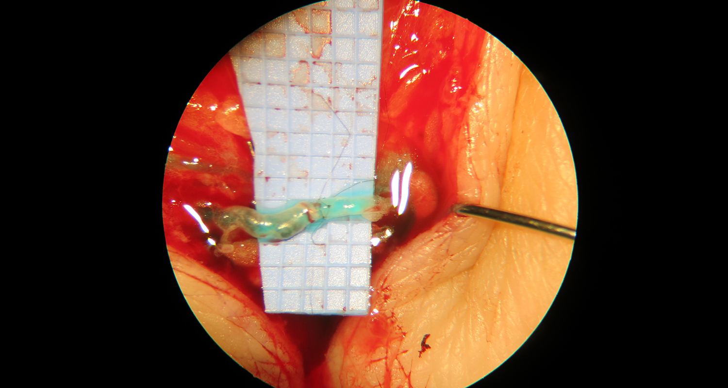 microsurgery: lymphovenous anastomosis under magnification