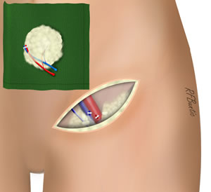 The Flap is Isolated