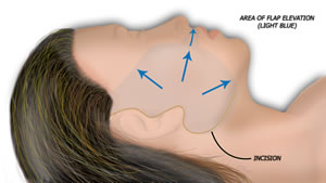 The Cross Facial Nerve Graft
