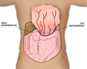 The Omentum is Elevated