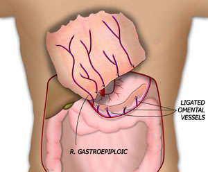 The Pedicle is Isolated
