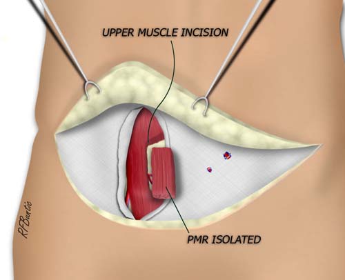 The Upper and Lower Muscle Incisions are Made