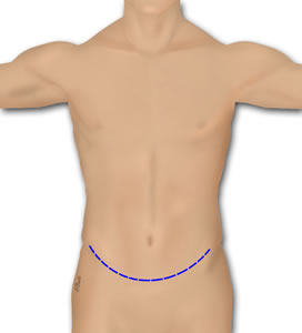 PMR Flap