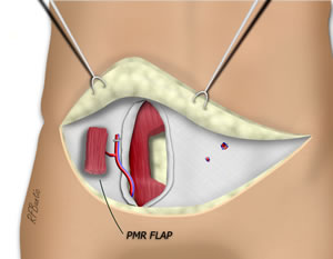 The PMR Flap is Isolated