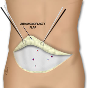 Exposing the Rectus Fascia