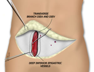 Exposing the Rectus Muscle and Pedicle