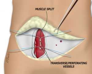 Identifying the Pedicle to the PMR