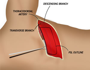 The Flap is Outlined