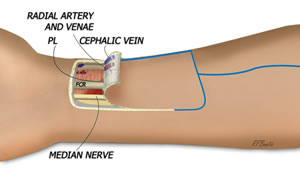 Elevation of the Flap