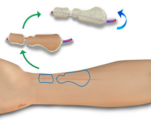Complex Radial Forearm Design