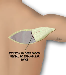 Elevation of the Flap
