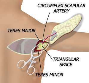 The flap is Elevated