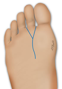 The Second Toe Incision
