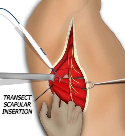 Transection of the Posterior Serratus Insertion
