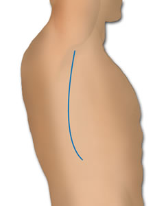 The Incision