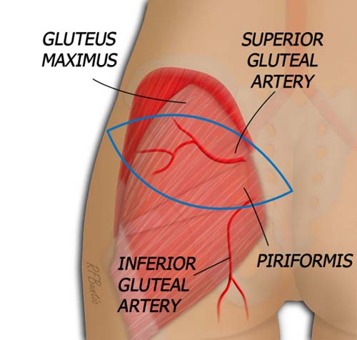 SGAP Anatomy Gluteus Removed
