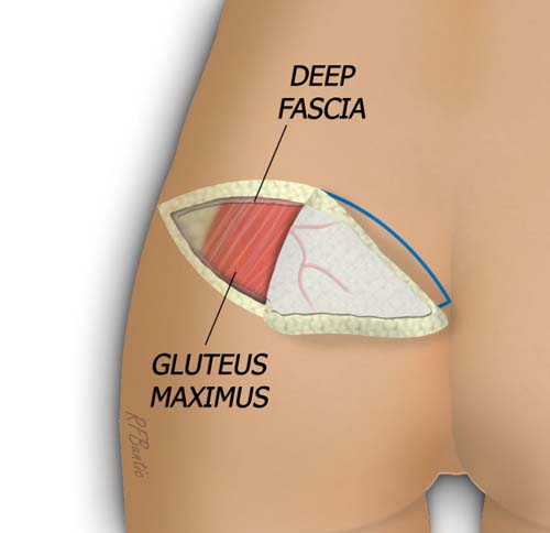 The Flap is Elevated from Lateral to Medial