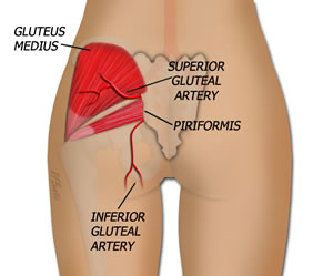 SGAP Anatomy Gluteus Removed