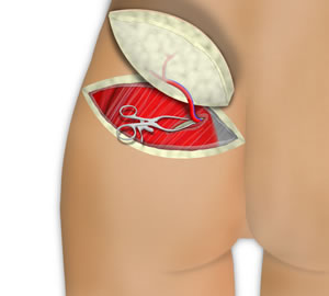 The Flap is Elevated