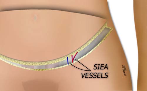 The Ipsilateral Flap is Elevated