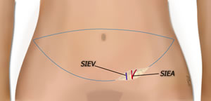 The Superficial Vessels Are Found