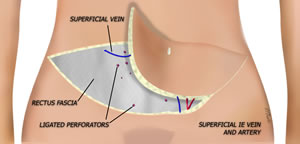 The Contralateral Flap is Elevated