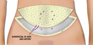 The Flap is Isolated