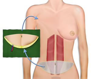 Isolating the SIEA Flap