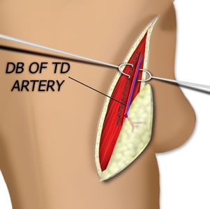 The Peforator is Dissected to the Pedicle