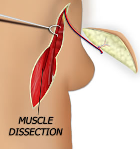 The Flap is Isolated