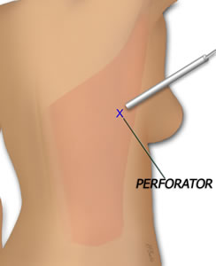 The Main Perforator is Identified