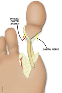 Plantar Flexor Transected