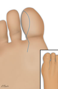 The Design of the Incision