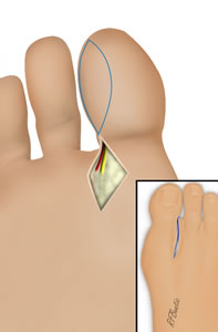 The Artery and Nerve Are Identified