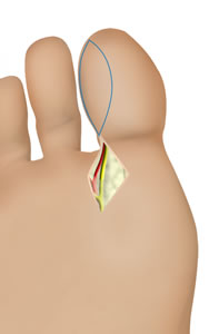 The Flap is Raised with the Pedicle