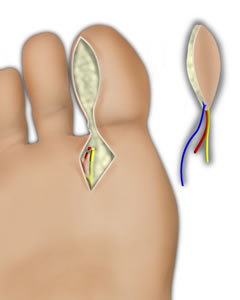 The Flap is Isolated