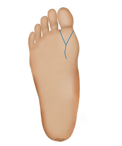 Plantar Incision