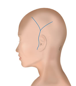 The Incision