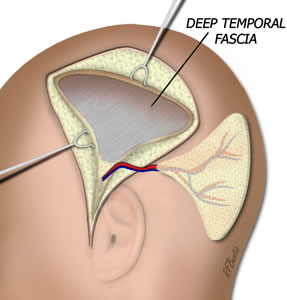 The Flap is Isolated