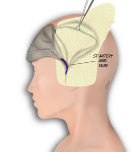 The Flap is Isolated