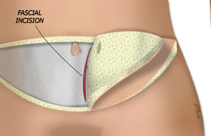 The Medial Fascia is Incised