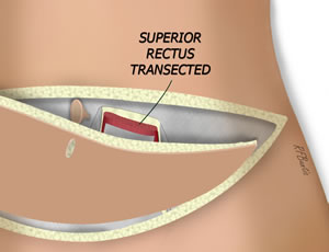 The Superior Fascia and Muscle are Incised