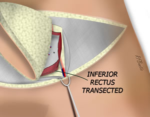 The Inferior Muscle is Incised
