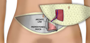 The Flap is Isolated