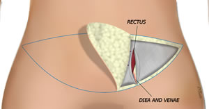 The Fascia is Incised
