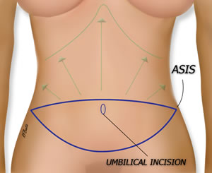 Marking for the DIEP flap
