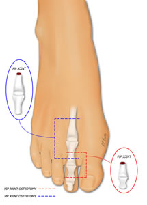 Vascular Anatomy of the ALT Flap