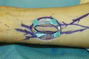 Venous Flap